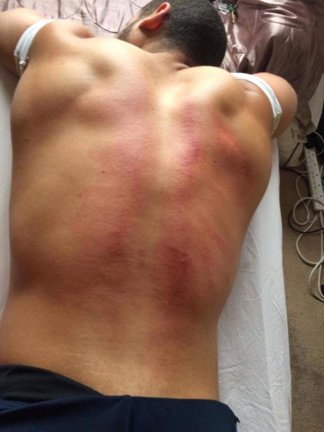 Looks pretty painful, right? Well, it actually relieves pain and stiffness in the area as well as fever, chill, coughing, wheezing, nausea and vomiting. It also helps improve blood circulation and reduces inflammation.