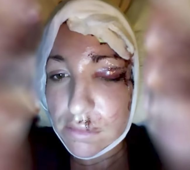 Abare has been visiting a plastic surgeon who hopes to one day heal her scalp to the point where she can receive a total hair transplant.