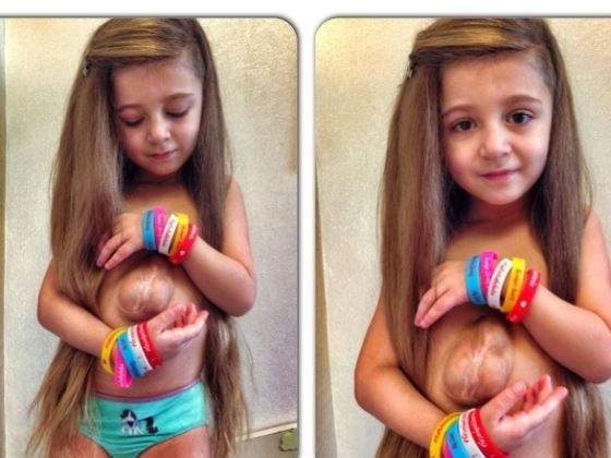 Virsaviya Borun (who goes by the name Bathsheba) was born with a rare condition called Pentalogy of Cantrell, and she was born with her heart outside of her body. More than 90 percent of babies born with this condition die, but Bathsheba has beaten the odds and survived even when doctors didn't believe she would. She's now eight years old, going to school, and having a relatively normal life apart from her medical issues.