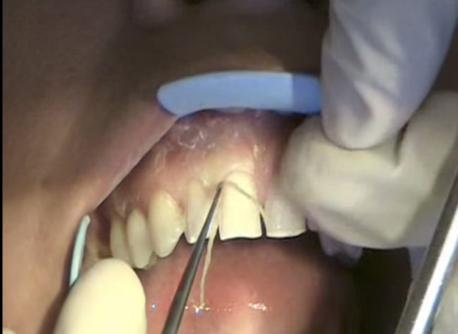 In this impression process, the dentist may insert retraction cord into the space between your gum line and your tooth. While it may look incredibly painful, this step is necessary to ensure your veneer tucks just underneath your gum line.