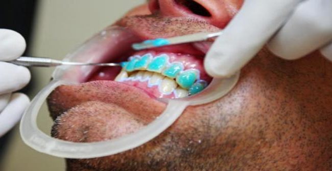 After washing off the trial paste and cleaning off the surface of your teeth by polishing the area before etching the surface with an acid etching gel. The etching gel creates a rough enamel surface, making it easier for the veneers to bond.