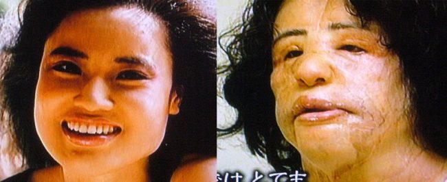 News of Mioku's story spread quickly, with some people taking pity on her and sending donations so she could have surgery to fix her enlarged, swollen face. While doctors were able to reduce its size, her face is permanently disfigured.