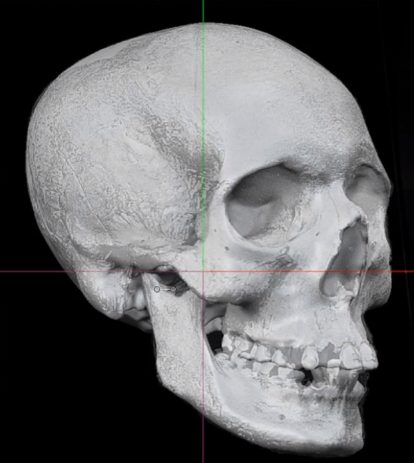 With the help of forensic scientist Dr. Christopher Rynn from the Centre for Anatomy and Human Identification at the University of Dundee, BBC Radio Scotland's "Time Travels" program has been able to use those photos and measurements to recreate Adie's face with state-of-the-art 3D virtual sculpture.