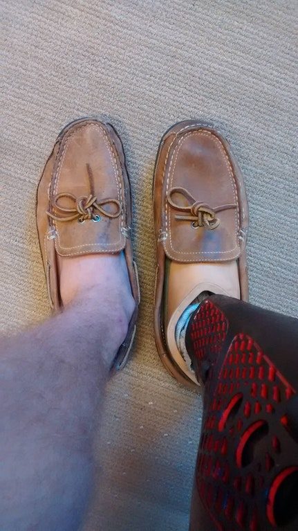 "The difference in shoe wear between my regular foot and my prosthetic foot after a year."