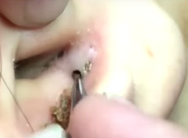 Blackheads in the ears come from not cleaning ears well enough, but you may be inserting dirty earbuds that exacerbate the issue. Always make sure you disinfect earbuds before inserting them in your sensitive ears. 