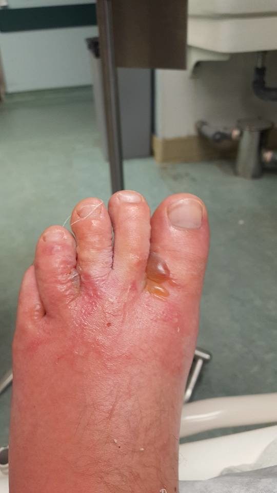 But when Zytner awoke one Saturday morning to find his feet were not only itchy but swollen, he decided to go to the hospital.