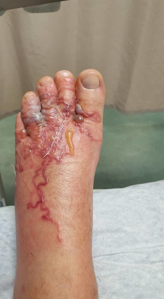 Often found in the intestines of cats, dogs, and wild animals, the larvae make their way into the skin of humans when they come in contact with sand or soil that has been contaminated by animal feces.