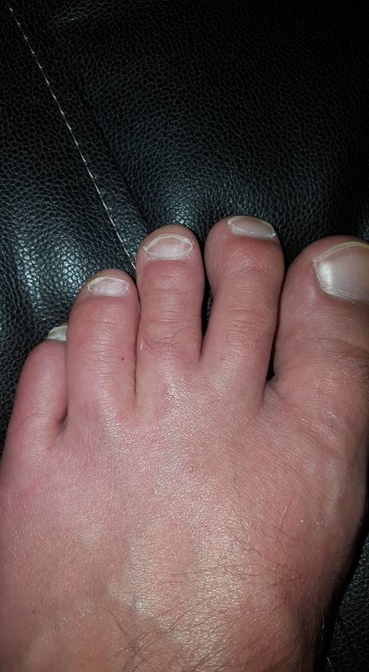 Initially, the couple wrote off the itching as nothing more than sand fleas, a common occurrence when you spend lots of time at the beach.