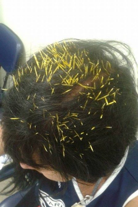 "A porcupine fell from a tree and fell on her head. The apex of unluckiness."