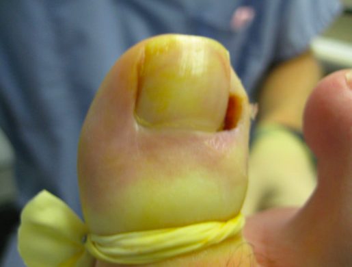 But if you're someone who's in relatively good health, there are ways that you can do this at home. Just be advised that if you have diabetes or any vascular condition, you cannot do this at home and must see a doctor immediately.