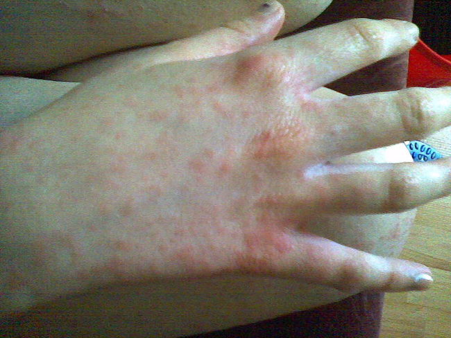 A Sunburn-Like Rash On Hands And Feet