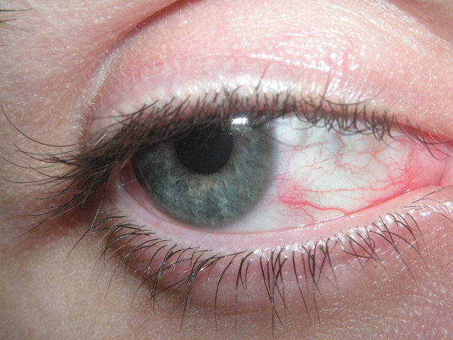 Redness in Mouth, Throat, And Eyes