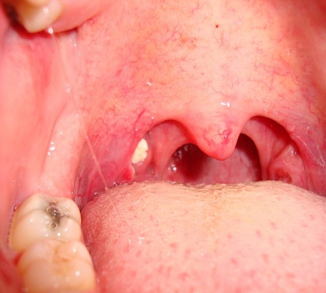 Swollen Tonsils